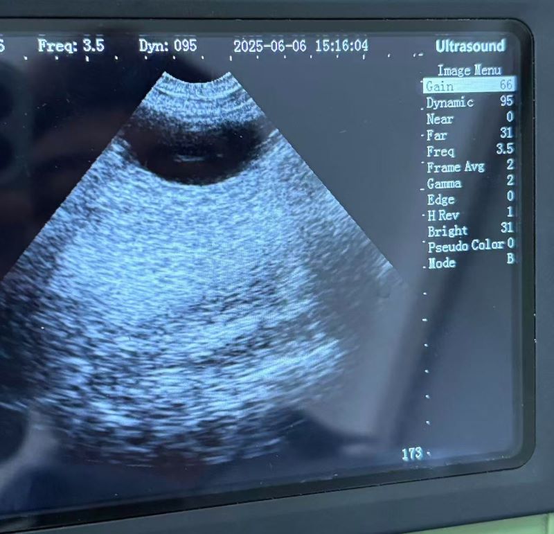 Bladder stones ultrasound