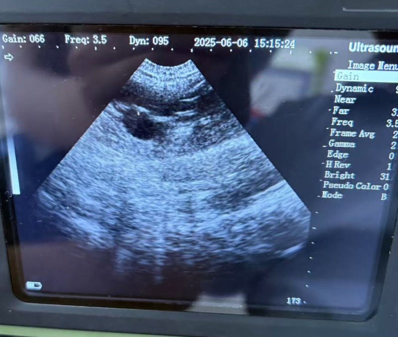 Liver tumor ultrasound