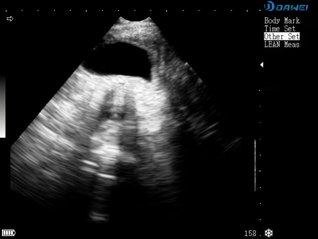 Liver tumor ultrasound
