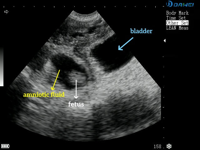 Bladder stones ultrasound